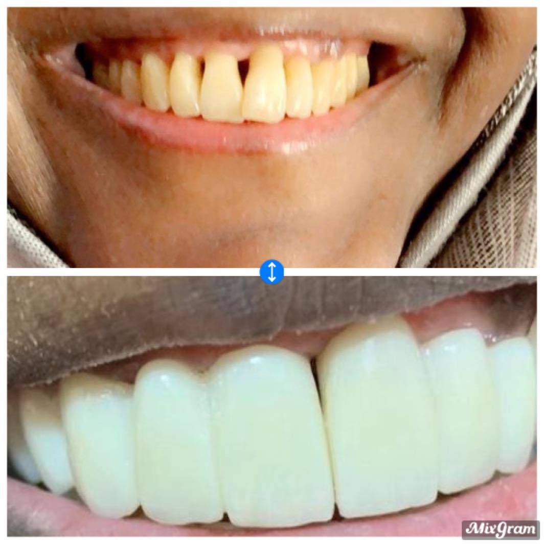 تجميل أسنان الفكين 